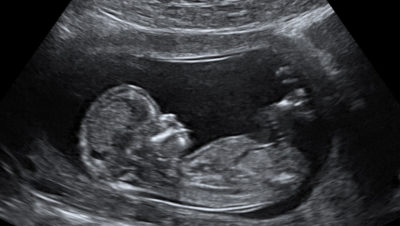 Ultrasound image of a 12-week fetus.